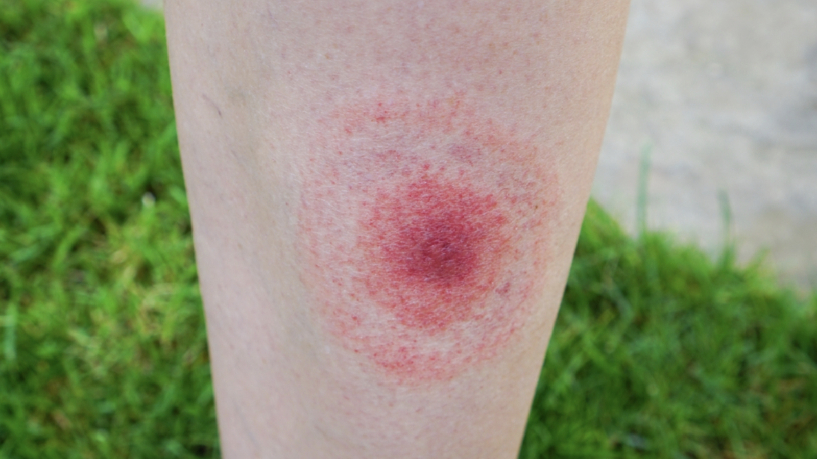 halsizlik ve kizariklik lyme hastaliginda sinsi tehlike tedavi edilmediginde kalici ve agir tablolara ilerleyebiliyor wYrOBy5U