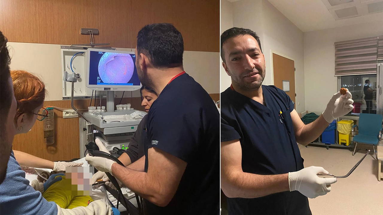 zihinsel engelli kadinin yemek borusuna kacan ceviz operasyonla cikarildi kjPHyIXp.jpg